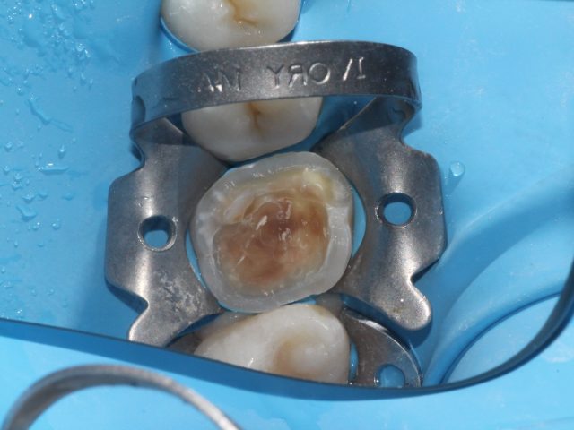endodonzia-ml-dental endodonzia