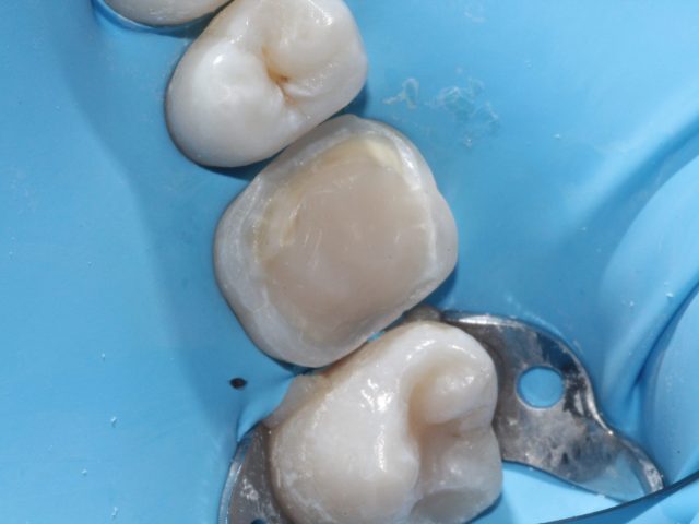 endodonzia-ml-dental-2 endodonzia
