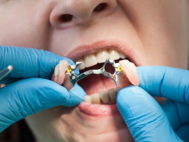 protesi-fissa-e-mobile-ml-dental protesi fissa e mobile